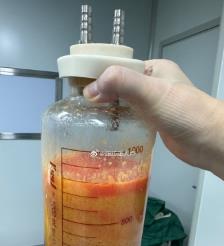 岳阳水动力吸脂手术要做多久？